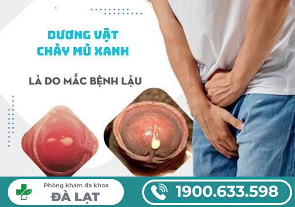 LỖ SÁO CHẢY MỦ: NGUYÊN NHÂN, TÁC HẠI VÀ PHƯƠNG PHÁP ĐIỀU TRỊ HIỆU QUẢ